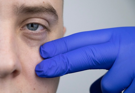 Is Under Eye Filler Suitable for Men?