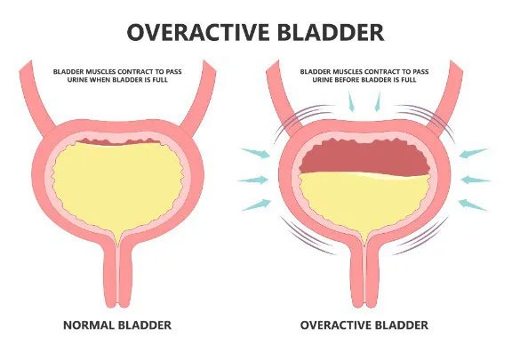 How Can Botox Help Overactive Bladders?